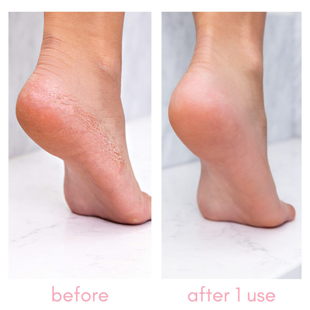 Heel-ing Callus Remover Diamond Nail Supplies