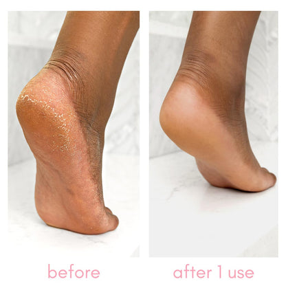 The Heel-ing Callus Remover Kit Diamond Nail Supplies